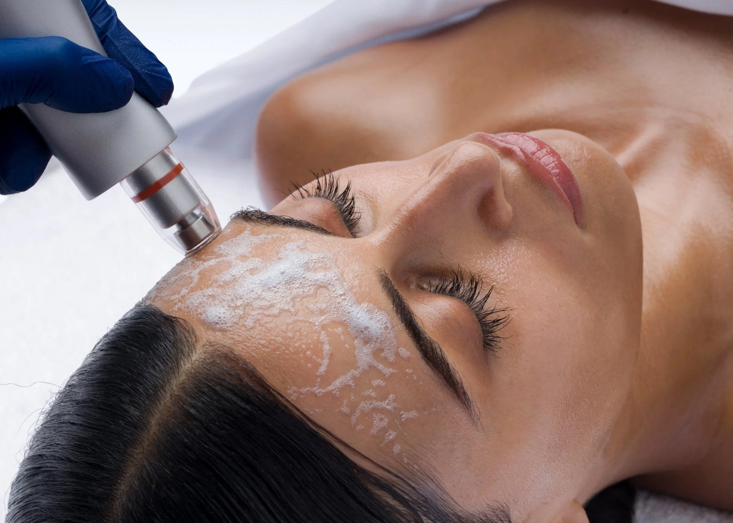 cavlamer hydradermabrasion