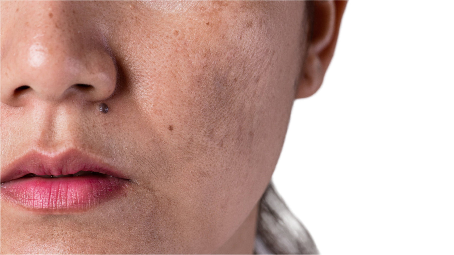 Hyperpigmentation treatment